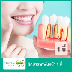 รักษารากฟันหน้า 1 ซี่