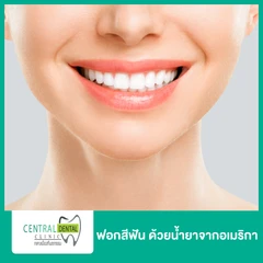 ฟอกสีฟันที่คลินิก ด้วยระบบ Cool Light น้ำยาจากอเมริกา