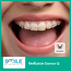 จัดฟันลวด Damon Q