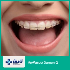 จัดฟันแบบ Damon Q