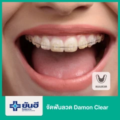 จัดฟันลวด Damon Clear
