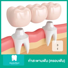 ทำสะพานฟัน (ครอบฟัน 3 ซี่)