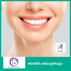 ฟอกสีฟัน ด้วยเลเซอร์ พร้อมขูดหินปูน