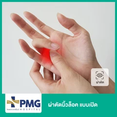 ผ่าตัดนิ้วล็อค แบบเปิด