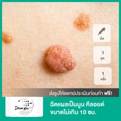 ฉีดแผลเป็นนูน คีลอยด์ ขนาดไม่เกิน 10 ซม. 1 จุด 1 ครั้ง