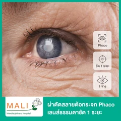 ผ่าตัดต้อกระจก สลายต้อด้วยคลื่นอัลตราซาวด์ เลนส์ธรรมดา พับได้ ชัด 1 ระยะ