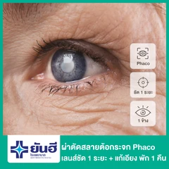 ผ่าตัดต้อกระจก สลายต้อด้วยคลื่นอัลตราซาวด์ เลนส์พับได้ ชัด 1 ระยะ และแก้สายตาเอียง สำหรับตา 1 ข้าง พักฟื้น 1 คืน
