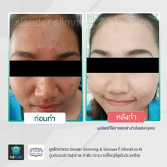 รักษาสิวด้วยเลเซอร์ (Acne Light Laser) 1 ครั้ง