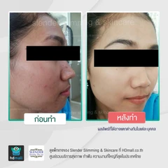 คอร์สรักษาสิวด้วยเลเซอร์ (Acne Light Laser) 3 ครั้ง