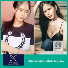 เสริมหน้าอกด้วยซิลิโคน Mentor 1 ครั้ง