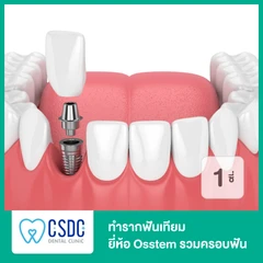 ทำรากฟันเทียม ยี่ห้อ Osstem รวมครอบฟัน 1 ซี่
