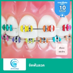 จัดฟันแบบโลหะ ฟันบนและล่าง