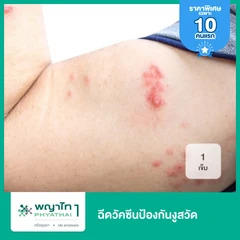 ฉีดวัคซีนป้องกันงูสวัด Shingles Vaccine (Shingrix) 1 เข็ม
