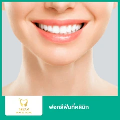 ฟอกสีฟันที่คลินิก ด้วยระบบ Philips Zoom