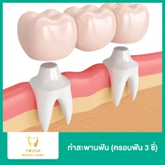 ทำสะพานฟัน (ครอบฟัน 3 ซี่)