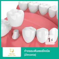 ทำครอบฟัน Zirconia สำหรับฟัน 1 ซี่