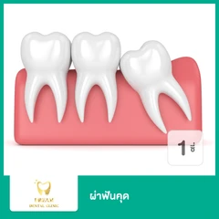 ผ่าฟันคุด 1 ซี่