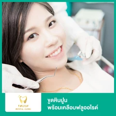 ขูดหินปูน พร้อมเคลือบฟลูออไรด์