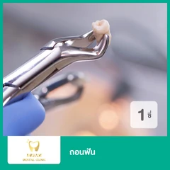 ถอนฟัน 1 ซี่