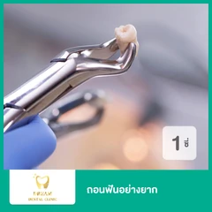 ถอนฟันอย่างยาก 1 ซี่