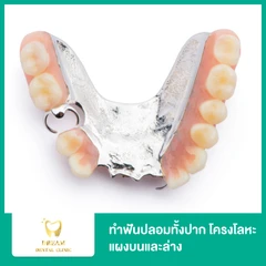 ทำฟันปลอมทั้งปาก โครงโลหะ แผงบนและล่าง 2 ชิ้น