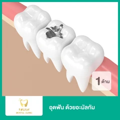 อุดฟันน้ำนม 1 ด้าน ด้วยอะมัลกัม
