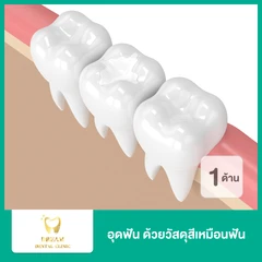 เคลือบหลุมร่องฟัน สำหรับฟันน้ำนม 1 ซี่