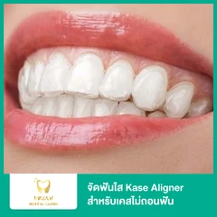 จัดฟันใส Kase Aligner ฟันบนและล่าง สำหรับเคสไม่ถอนฟัน