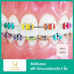 จัดฟันแบบโลหะ ฟันบนและล่าง ฟรี! รีเทนเนอร์แบบใส 2 ชิ้น ฟันบนและล่าง