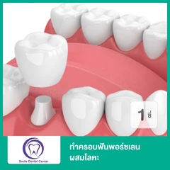 ทำครอบฟันพอร์ซเลนผสมโลหะ สำหรับฟัน 1 ซี่
