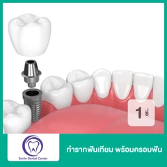 ทำรากฟันเทียม ยี่ห้อ Neo Biotech พร้อมครอบฟัน สำหรับฟัน 1 ซี่