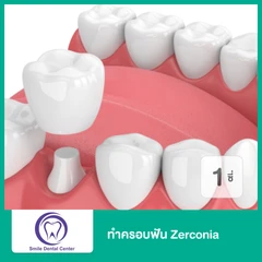 ทำครอบฟัน Zirconia เซรามิกล้วน สำหรับฟัน 1 ซี่