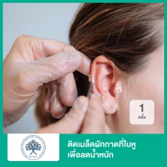 ติดเมล็ดผักกาดที่ใบหูเพื่อลดน้ำหนัก 1 ครั้ง