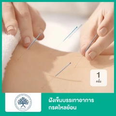 ฝังเข็มบรรเทาอาการกรดไหลย้อน 1 ครั้ง