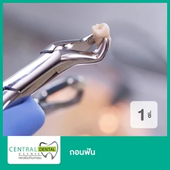 ถอนฟัน 1 ซี่