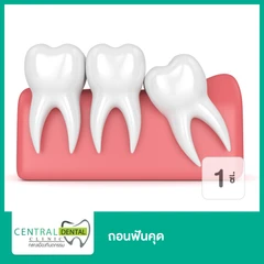 ถอนฟันคุด 1 ซี่