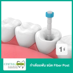 ทำเดือยฟัน ชนิด Fiber Post สำหรับฟัน 1 ซี่