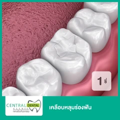 เคลือบหลุมร่องฟัน สำหรับฟัน 1 ซี่