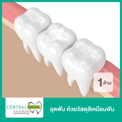 อุดฟัน 1 ด้าน ด้วยวัสดุสีเหมือนฟัน