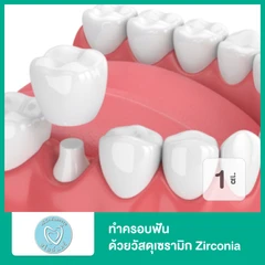 ทำครอบฟัน ด้วยวัสดุเซรามิก Zirconia สำหรับฟัน 1 ซี่