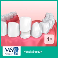 ทำวีเนียร์เซรามิก สำหรับฟัน 1 ซี่