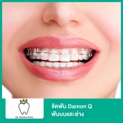 จัดฟัน Damon Q ฟันบนและล่าง