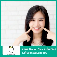 จัดฟัน Damon Clear แบร็กเกตใส ไม่เห็นลวด ฟันบนและล่าง