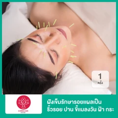 ฝังเข็มรักษารอยเเผลเป็น ริ้วรอย ปาน ขี้เเมลงวัน ฝ้า กระ พร้อมครอบเเก้วเพื่อปรับสมดุลร่างกาย 1 ครั้ง