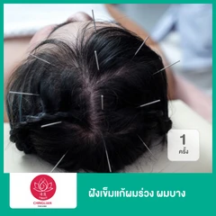 ฝังเข็มแก้ผมร่วง ผมบาง 1 ครั้ง