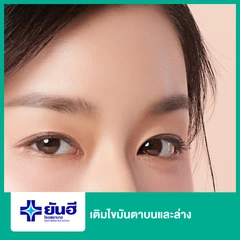 เติมไขมันตาบนและตาล่าง