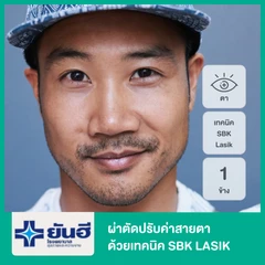 ผ่าตัดปรับค่าสายตา ด้วยเทคนิค SBK LASIK สำหรับตา 1 ข้าง