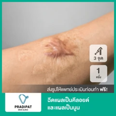 ฉีดแผลเป็นคีลอยด์และแผลเป็นนูน ขนาด 5x5 ซม. 3 จุด 1 ครั้ง