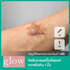 ฉีดรักษาแผลเป็นคีลอยด์ขนาดไม่เกิน 1 นิ้ว 1 ครั้ง