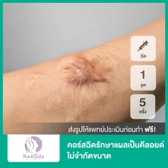 คอร์สฉีดรักษาแผลเป็นคีลอยด์ 1 จุด ไม่จำกัดขนาด 5 ครั้ง